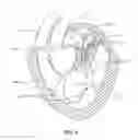Fig. 06 - Sequentially deployed transcatheter mitral valve prosthesis