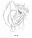 Fig. 22 - Sequentially deployed transcatheter mitral valve prosthesis