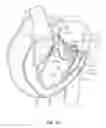 Fig. 28 - Sequentially deployed transcatheter mitral valve prosthesis