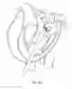 Fig. 33 - Sequentially deployed transcatheter mitral valve prosthesis