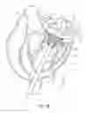 Fig. 35 - Sequentially deployed transcatheter mitral valve prosthesis