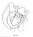 Fig. 40 - Sequentially deployed transcatheter mitral valve prosthesis