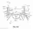 Fig. 41 - Sequentially deployed transcatheter mitral valve prosthesis