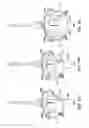 Fig. 46 - Sequentially deployed transcatheter mitral valve prosthesis