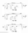 Fig. 52 - Sequentially deployed transcatheter mitral valve prosthesis