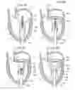 Fig. 09 - Transcatheter device for treating mitral regurgitation