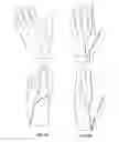 Fig. 07 - WEARABLE AND FUNCTIONAL HAND ORTHOTIC