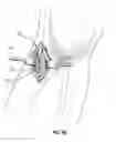 Fig. 08 - Subcutaneous vascular access ports and related systems and methods
