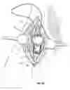 Fig. 09 - Subcutaneous vascular access ports and related systems and methods
