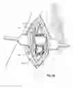 Fig. 10 - Subcutaneous vascular access ports and related systems and methods
