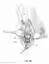 Fig. 16 - Subcutaneous vascular access ports and related systems and methods