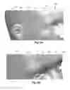Fig. 05 - Systems and methods for introducing an electrical stimulation lead into a patient
