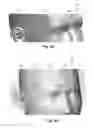 Fig. 06 - Systems and methods for introducing an electrical stimulation lead into a patient