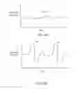 Fig. 08 - Ambulatory phrenic nerve stimulation detection