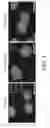 Fig. 05 - COMPOSITIONS AND METHODS FOR SCREENING PEDIATRIC GLIOMAS AND METHODS OF TREATMENT THEREOF
