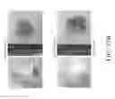 Fig. 48 - COMPOSITIONS AND METHODS FOR SCREENING PEDIATRIC GLIOMAS AND METHODS OF TREATMENT THEREOF