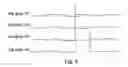 Fig. 04 - GOA circuit for solving problem of voltage level maintenance at the node Q