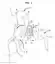 Fig. 02 - Reconfigurable intra-auricular support