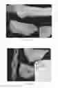 Fig. 08 - DETECTING EARLY TISSUE DAMAGE RESULTING FROM MECHANICAL DEFORMATION, SHEAR, FRICTION, AND/OR PROLONGED APPLICATION OF PRESSURE