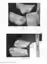 Fig. 09 - DETECTING EARLY TISSUE DAMAGE RESULTING FROM MECHANICAL DEFORMATION, SHEAR, FRICTION, AND/OR PROLONGED APPLICATION OF PRESSURE