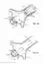 Fig. 09 - Method and system for balloon counterpulsation during aortic valve replacement