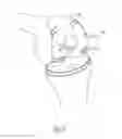 Fig. 08 - Revision joint replacement device and method