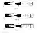 Fig. 02 - Device for the controlled removal of osseointegrated implants and improved osseodisintegratable implants