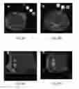 Fig. 09 - Immunotherapeutic methods using irreversible electroporation