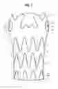 Fig. 02 - ENDOLUMINAL PROSTHESIS WITH AN AORTIC SINUS STENT ASSEMBLY