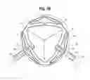 Fig. 07 - ENDOLUMINAL PROSTHESIS WITH AN AORTIC SINUS STENT ASSEMBLY