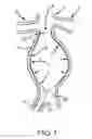 Fig. 02 - Methods and systems for aneurysm stabilization and treatment