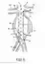 Fig. 07 - Methods and systems for aneurysm stabilization and treatment