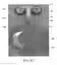 Fig. 08 - Thoracic lumbar sacral orthosis attachment