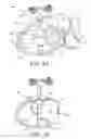 Fig. 09 - Thoracic lumbar sacral orthosis attachment