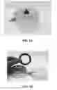 Fig. 02 - Vaginal ring with visual indication of use