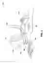 Fig. 02 - Twisting biventricular cardiac assist device