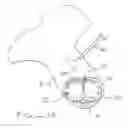 Fig. 08 - Devices and methods for reshaping blood vessels