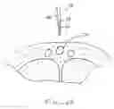 Fig. 09 - Devices and methods for reshaping blood vessels
