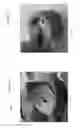 Fig. 43 - Device, system, and method for transcatheter treatment of valvular regurgitation