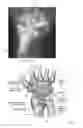 Fig. 02 - Implant for total wrist replacement