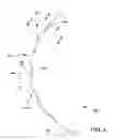 Fig. 07 - Ocular implant with pressure sensor and delivery system