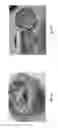 Fig. 12 - Abuse deterrent formulations of amphetamine
