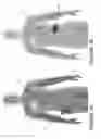 Fig. 09 - Transcutaneous energy transfer systems