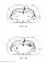Fig. 05 - Electrical substance clearance from the brain