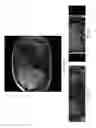 Fig. 07 - Free-breathing 3D body diffusion imaging using motion-compensated diffusion preparation and motion robust readout