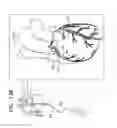 Fig. 27 - Tissue anchors with hemostasis seal