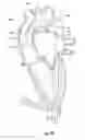 Fig. 09 - Aortic occlusion device