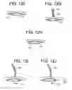 Fig. 12 - Method and devices for a sub-splenius/supra-levator scapulae surgical access technique
