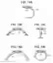 Fig. 14 - Method and devices for a sub-splenius/supra-levator scapulae surgical access technique