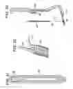 Fig. 23 - Method and devices for a sub-splenius/supra-levator scapulae surgical access technique